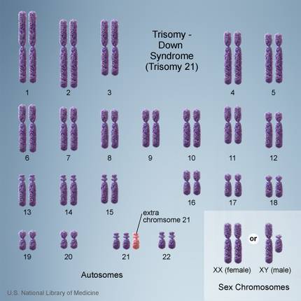 downen-sindromea-kromosoma-gehigarriaren-eragina-g