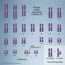 Downen sindromea: kromosoma gehigarriaren eragina, genoma osoan