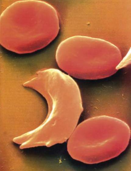 hemoglobina-gaztetu-anemia-faltziformea-sendatzeko