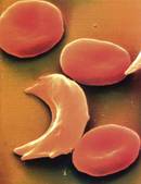 Hemoglobina gaztetu,  anemia faltziformea sendatzeko 