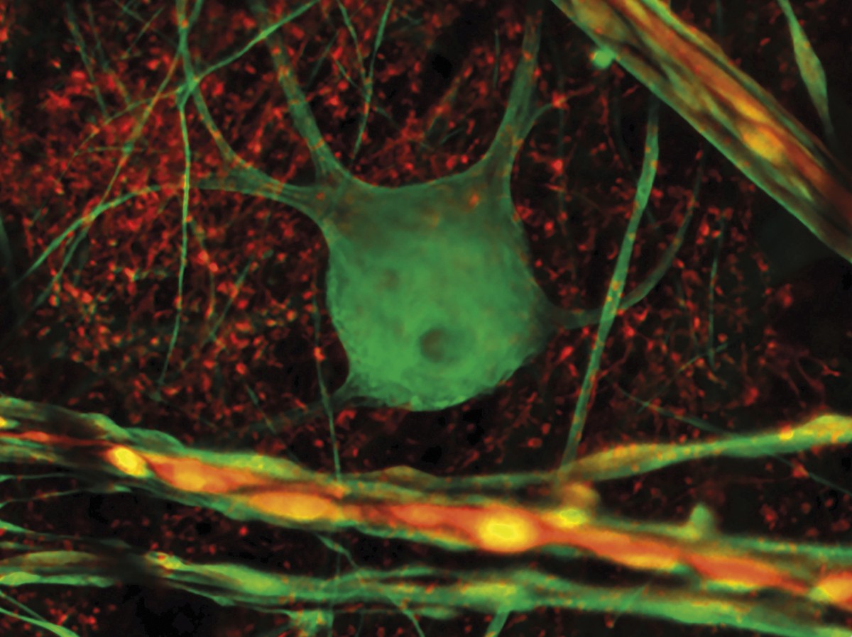 Gongoil-neurona erraldoia
